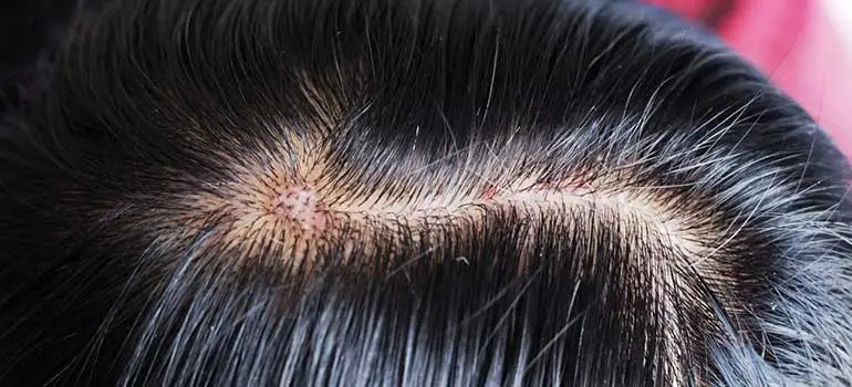 Allergic Reactions In Scalp