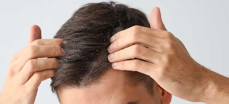 Dandruff & Dry Scalp