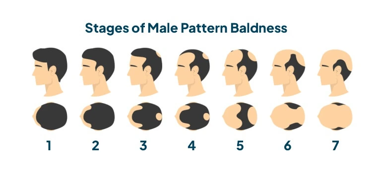 The Ultimate Guide to Male Pattern Baldness Solutions-in-London 01