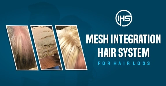 Mesh Integration Hair System For Hair Loss